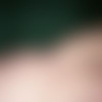 Lipoatrophie:&nbsp;typische "BH-Träger"-Lipoatrophie. Diese bandförmige Lipoatrophie entsteht dur...
