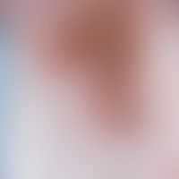 Retikulohistiozytose(n). Disseminierte bis linsengroße, rötlich-bräunliche Papeln im Bereich der ...