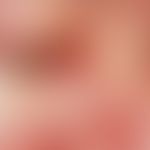 Hidrozystom. Infraorbital lokalisierter, von Teleangiektasien durchzogener, bläulich-weißlicher, ...