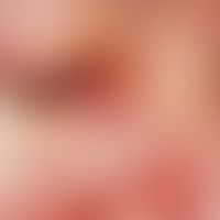 Hidrozystom. Infraorbital lokalisierter, von Teleangiektasien durchzogener, bläulich-weißlicher, ...
