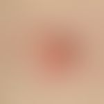Nodules: for 2 years slowly growing, 1.8 cm large, asymptomatic, firm, shifting, red, smooth nodu...