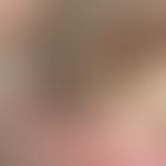 Node brown. solitary, chronically stationary, soft, lobed, symptomless, brown node (Verruca sebor...