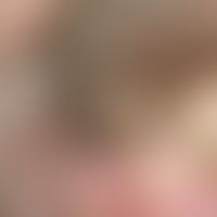 Node brown. solitary, chronically stationary, soft, lobed, symptomless, brown node (Verruca sebor...