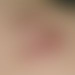 Nodules: Keloids : Chronically dynamic, continuously growing for 2 years, hard, red, polypose nod...