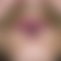 Nodules: Chronic stationary, bulging elastic, blackberry-coloured, slow-growing, asymptomatic, sm...