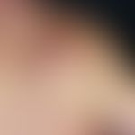 Nodules: Subjectively little disturbing, 6.0 x 6.0 cm large, soft, elastic, laterally well defina...