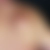 Knoten:&nbsp;Subjektiv wenig störender, 6,0 x 6,0 cm großer, weicher, elastischer, seitlich gut a...