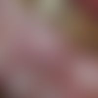 abscess. periodontal abscess. acute, 0.8 cm large, strongly pressure-dolent, bulging elastic, cys...