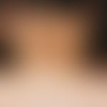 Acanthosis nigricans:&nbsp;graubraune, papillomatös-hyperkeratotische, flächenhafte, unscharf beg...