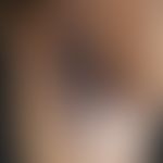 Acanthosis nigricans:&nbsp;&nbsp;axillär beidseits ausgeprägte, graubraune, papillomatös-hyperker...
