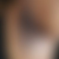 Acanthosis nigricans: Bilateral greyish-brown, papillomatous-hyperkeratotic, asymptomatic, flat, ...