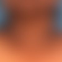 Acanthosis nigricans benigna bei bekanntem Diabetes mellitus
