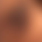 Acanthosis nigricans benigna: bekannter Diabetes mellitus.&nbsp;Samtartige, verruköse Umwandlung ...
