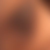 Acanthosis nigricans benigna: bekannter Diabetes mellitus.&nbsp;Samtartige, verruköse Umwandlung ...