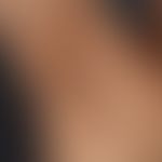 Acanthosis nigricans benigna: unscharf abgrenzbare,&nbsp;hyperpigmentierte, verruköse Plaques. Hy...