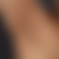 Acanthosis nigricans benigna: unscharf abgrenzbare,&nbsp;hyperpigmentierte, verruköse Plaques. Hy...