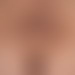 Acanthosis nigricans benigna: unscharf begrenzte braun-schwarze, stellenweise, leicht verruköse P...