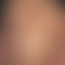 Acanthosis nigricans maligna. Generalisierter Befall mit hyperkeratotischen, teils exkoriierten P...