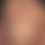 Acanthosis nigricans maligna: Generalized infestation with hyperkeratotic, partially excoriated p...
