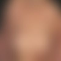Acanthosis nigricans maligna: Generalized infestation with hyperkeratotic, partially excoriated p...