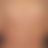 Acanthosis nigricans maligna. Starker Befall des Rückens mit hyperkeratotischen Papeln auf gelbbr...