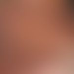Acanthosis nigricans maligna: asymptomatic brown coloration of the skin and hyperkeratosis in the...