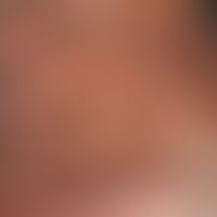 Acanthosis nigricans maligna:&nbsp;seit ca. 3-4 Monaten bestehende, asymptomatische Braunfärbung ...
