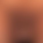 Acanthosis nigricans maligna: generalized infestation with hyperkeratotic, beet-like aggregated, ...
