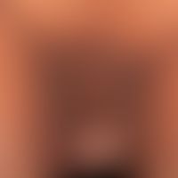 Acanthosis nigricans maligna: generalized infestation with hyperkeratotic, beet-like aggregated, ...
