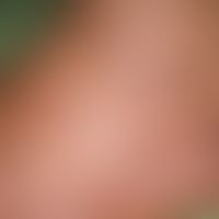 Acrodermatitis chronica atrophicans (wenig entzündlich):&nbsp;braun-rotes&nbsp;Erythem in atrophi...