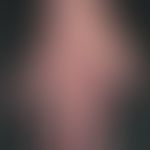 Acrodermatitis chronica atrophicans: Livid erythema on the back of the right hand and nail dystro...