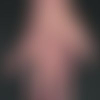 Acrodermatitis chronica atrophicans: livide Erytheme am rechten Handrücken sowie Nageldystrophien...