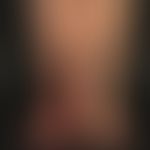 Acrodermatitis chronica atrophicans: Symptoms existing for 1 year with an acral accentuated, inho...