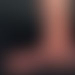 Acrodermatitis chronica atrophicans. cigarette-paper-like wrinkles on the edematous swollen, flat...