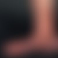 Acrodermatitis chronica atrophicans. cigarette-paper-like wrinkles on the edematous swollen, flat...