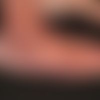 Acrodermatitis chronica atrophicans:&nbsp;deutlich sichtbare, schlaffe Hautatrophie und ödematöse...