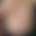 acrodermatitis chronica atrophicans. 57-year-old female patient. skin changes existing for five y...