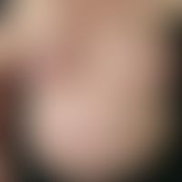 acrodermatitis chronica atrophicans. 57-year-old female patient. skin changes existing for five y...