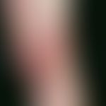 Acrodermatitis chronica atrophicans. 78-year-old female patient with confirmed neuroborreliosis 6...