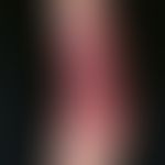 Acrodermatitis chronica atrophicans: Initially flat, oedematous, livid red plaques; beginning tra...