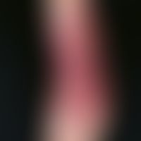 Acrodermatitis chronica atrophicans: Initially flat, oedematous, livid red plaques; beginning tra...