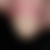Acrodermatitis continua suppurativa. Komplette Zerstörung des Nagelorgans am Daumenendglied der r...