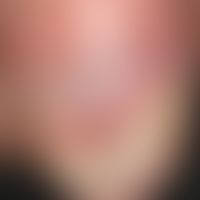 Acrodermatitis continua suppurativa. Seit 3 Jahren persistierende, therapieresistente Veränderung...