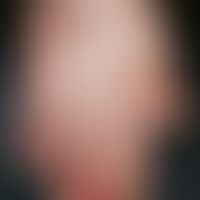 Acrodermatitis continua suppurativa:&nbsp;chronische, rote, schuppige&nbsp;Plaques mit rezidivier...
