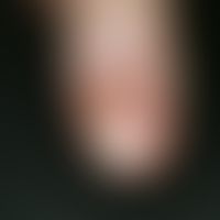Acrodermatitis continua suppurativa. Rezidivierende, zu Mutilationen neigende, sterile Pustelerkr...