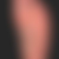 Acrodermatitis continua suppurativa. moderate infestation of the feet. grouped blisters and isola...