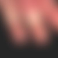 Acrodermatitis continua suppurativa:pronounced sterile-pustular, acral dermatitis with extensive ...