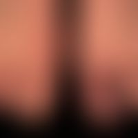 Acrodermatitis continua suppurativa. severe mutating, chronic pustular dermatitis with complete d...