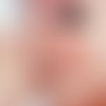 Acrodermatitis papulosa eruptiva infantilis. Akut aufgetretenes Exanthem mit disseminierten, im Z...