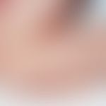 Acrodermatitis papulosa eruptiva infantilis. Disseminierte Aussaat entzündlicher Papeln an den Ex...